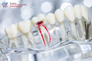 Root Canal Treatment