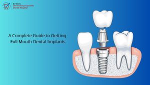 Full Mouth Dental Implants